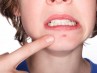 Acne giovanile o in età adulta: come evitarla Acne giovanile o in età adulta: come evitarla